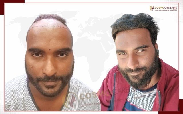 Before hair transplant, receding hairline